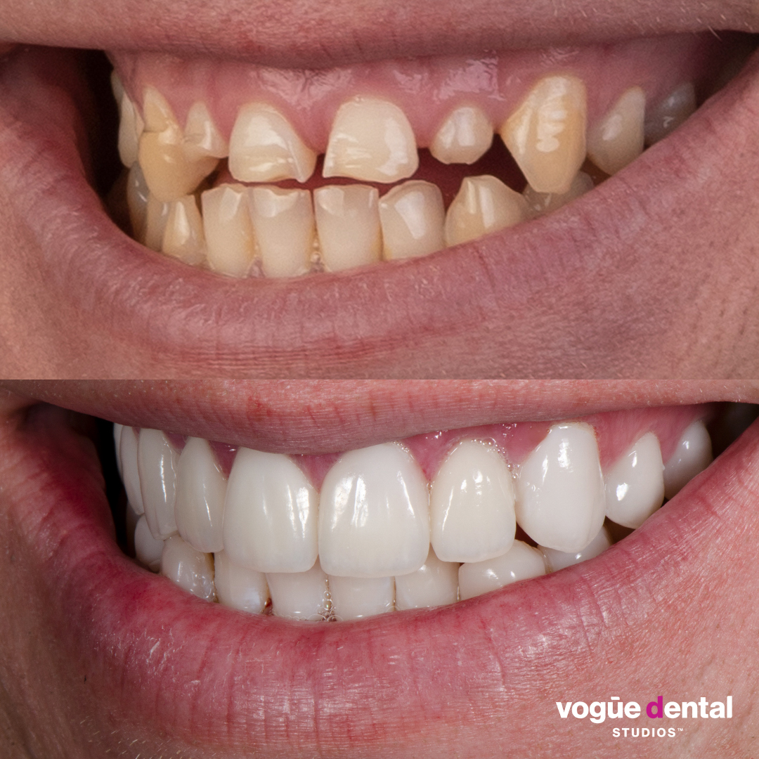 Before and after missing teeth with porcelain veneers at Vogue Dental Studios - Right teeth view Dean A