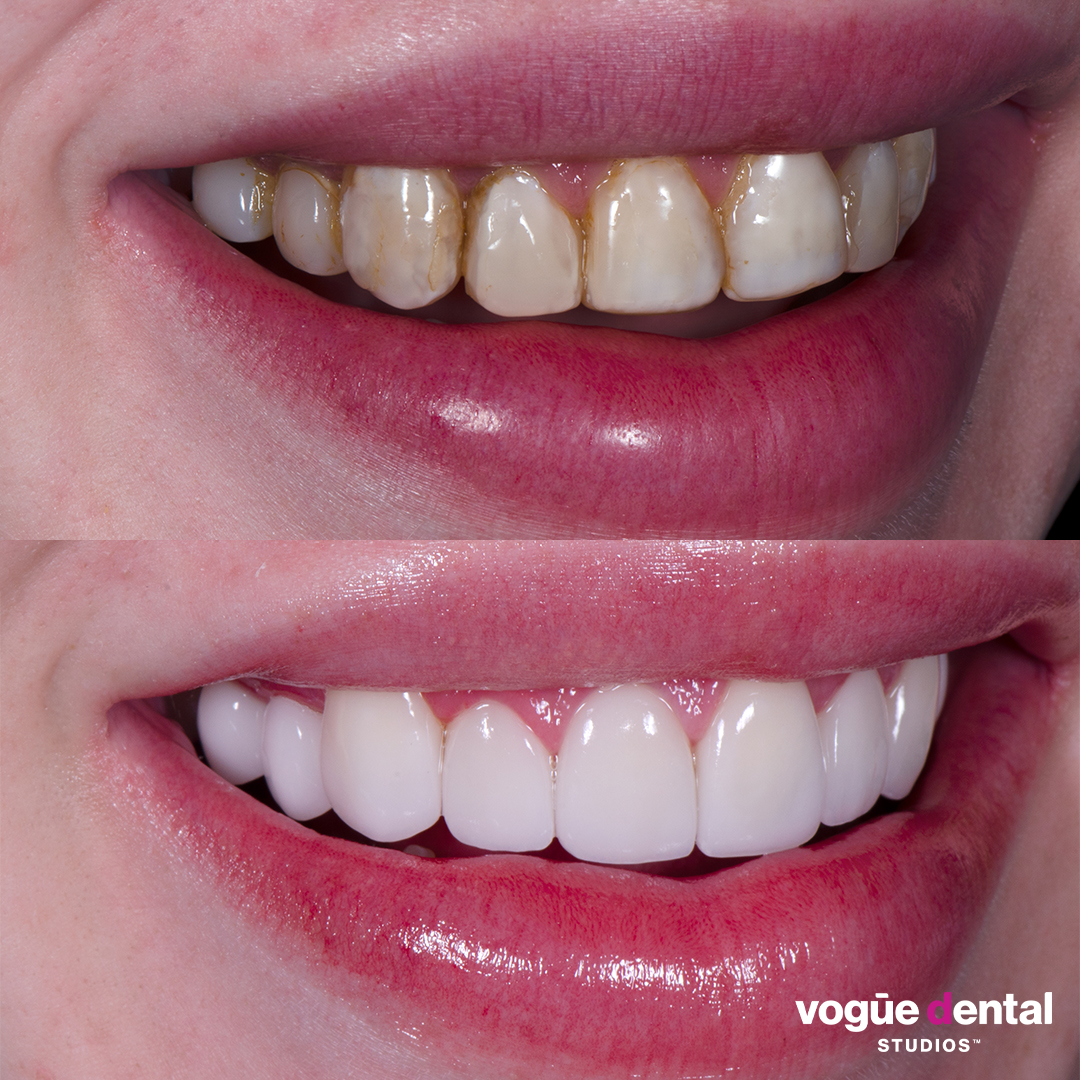 Before and after old composite veneers with porcelain veneers at Vogue Dental Studios - right teeth view Jack.