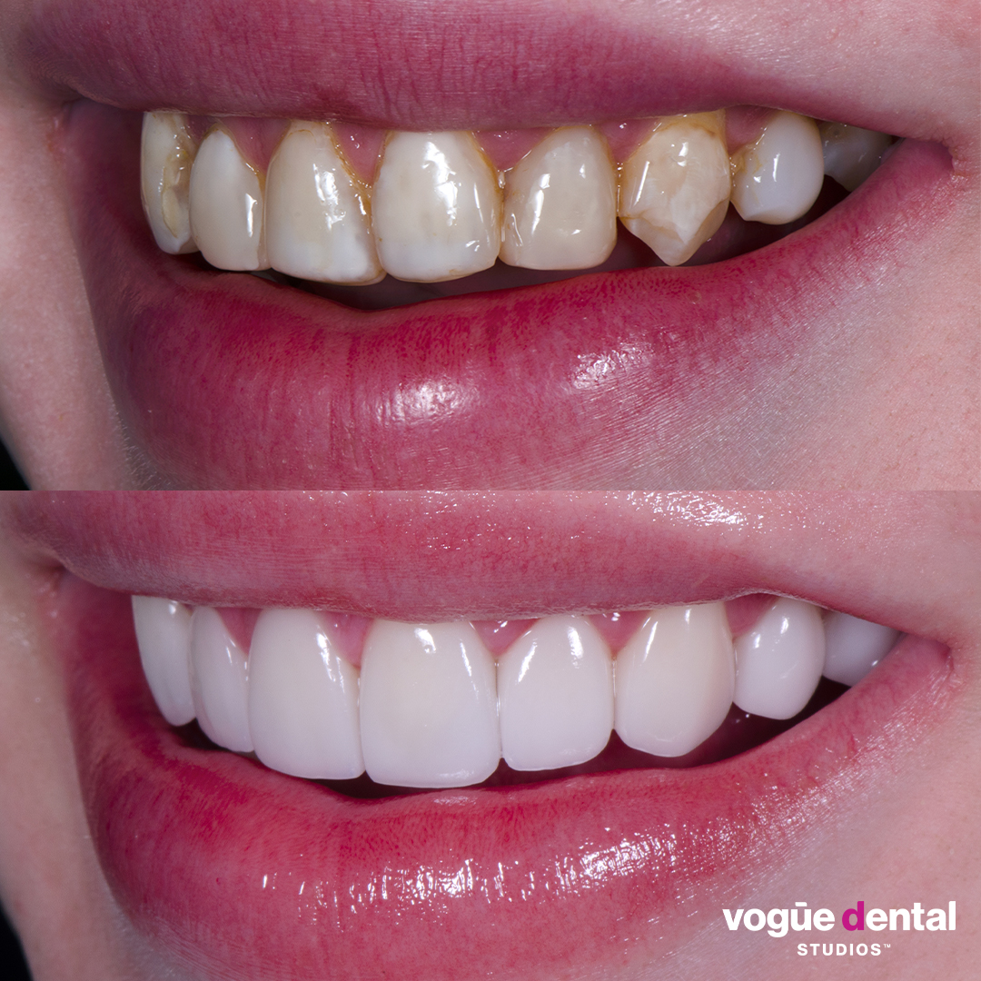 Before and after old composite veneers with porcelain veneers at Vogue Dental Studios - left teeth view Jack.