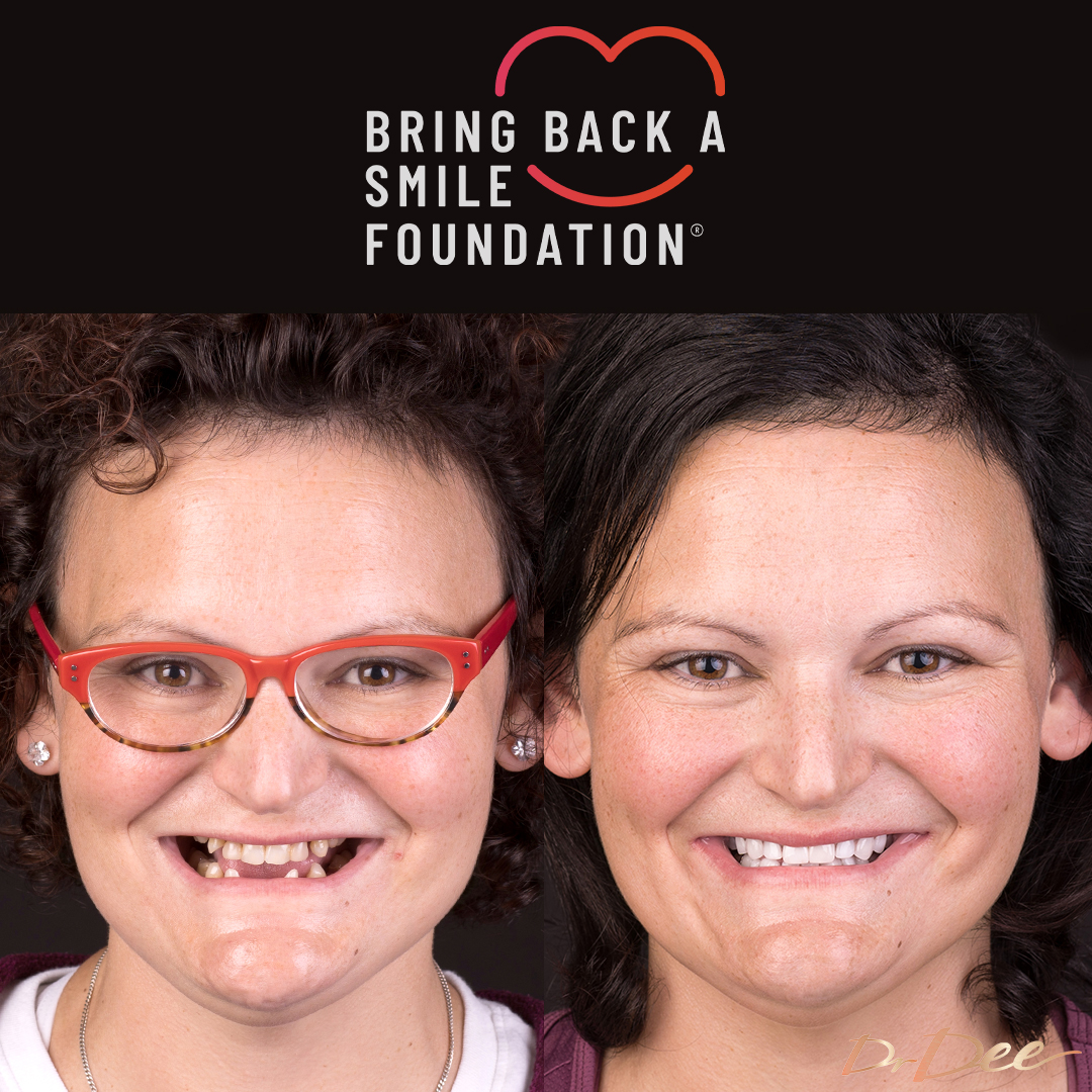 Bring Back a Smile Foundation patient Jacqui before and after veneers gaps