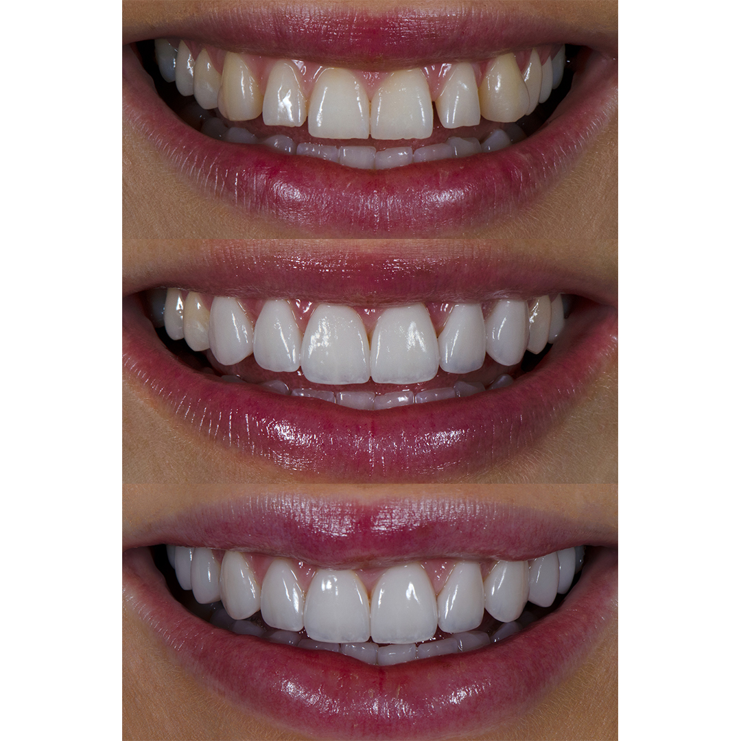 Renee Stewart from Christchurch before and after six, and after ten dental veneers at Vogue Dental Studios.