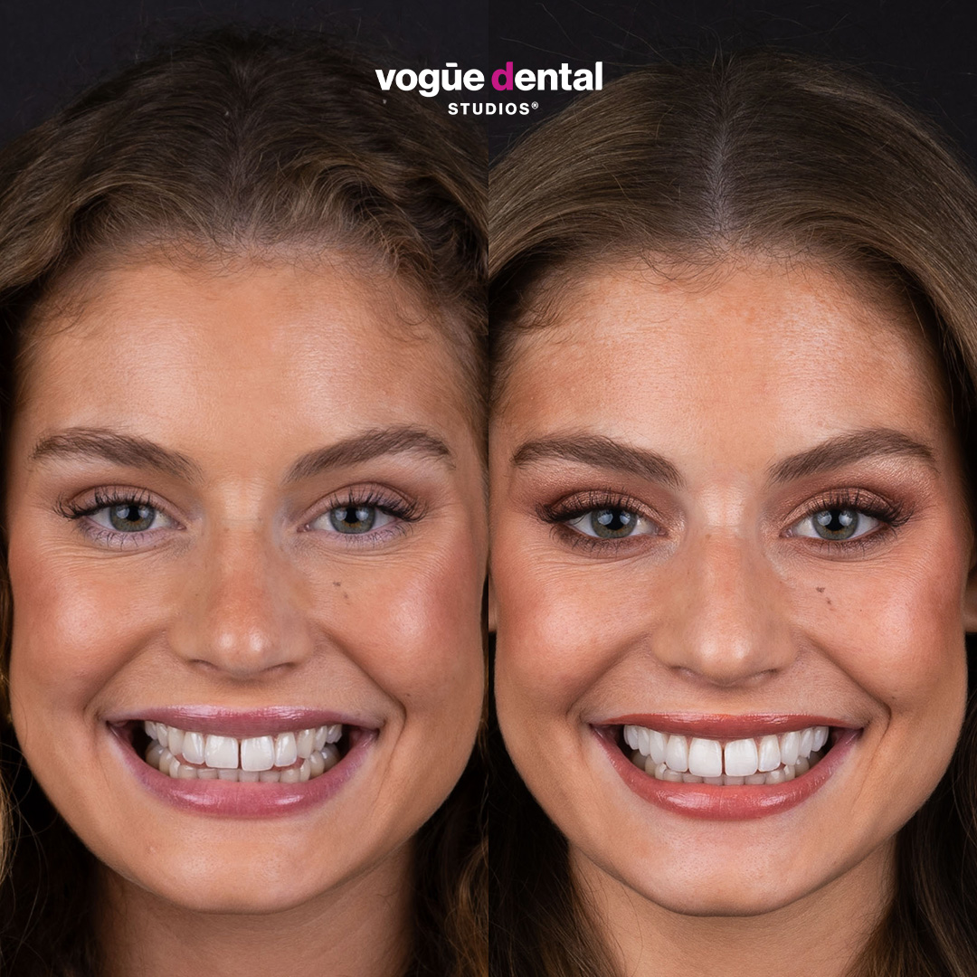 Before and after chipped teeth with porcelain veneers at Vogue Dental Studios - front view Moraya.