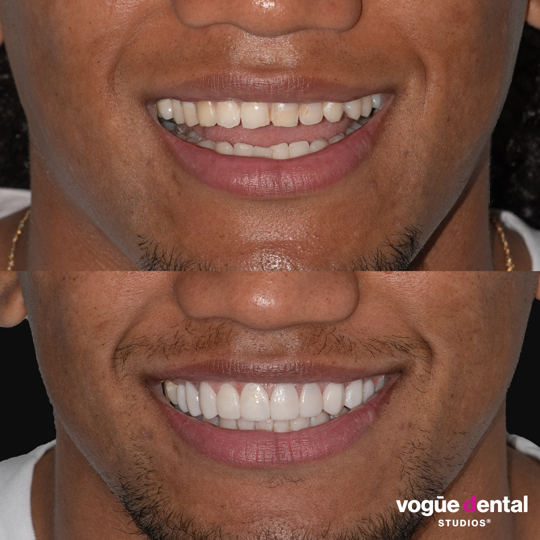 Sitili Tupouniua before and after porcelain veneers Vogue Dental Studios - half face front
