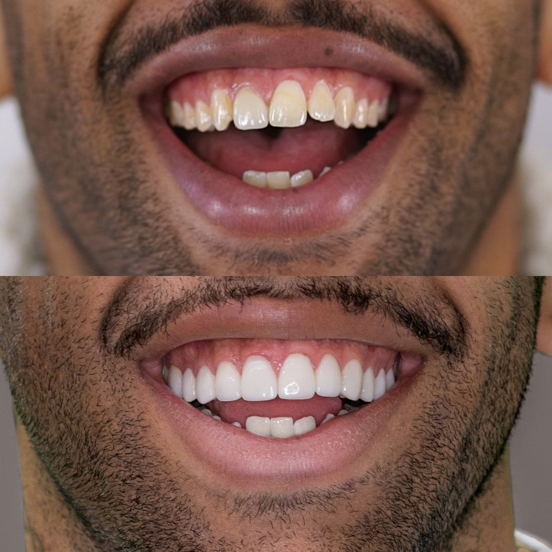 Josh Addo Carr teeth porcelain veneer smile makeover transformation by Dr Dee.