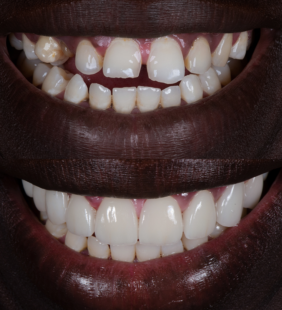 Before and after missing teeth with porcelain veneers by Dr Dee - Joseph Deng