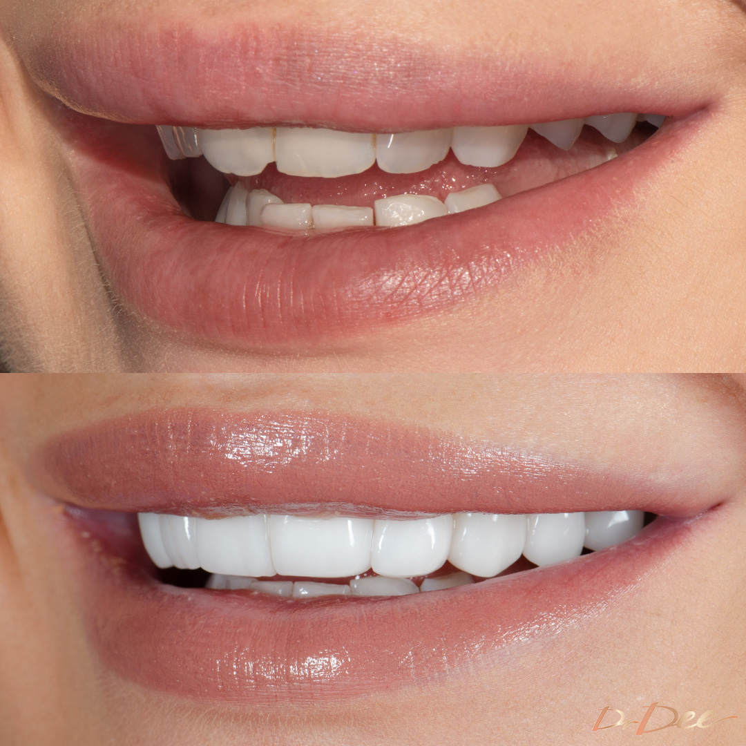 Melbourne Chippy Chick Stefanie porcelain veneers for narrow smile by Dr Dee - left view