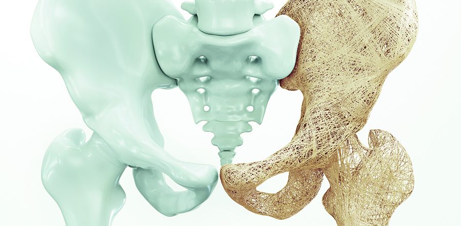 Imagen-1A-osteoporosis.jpg