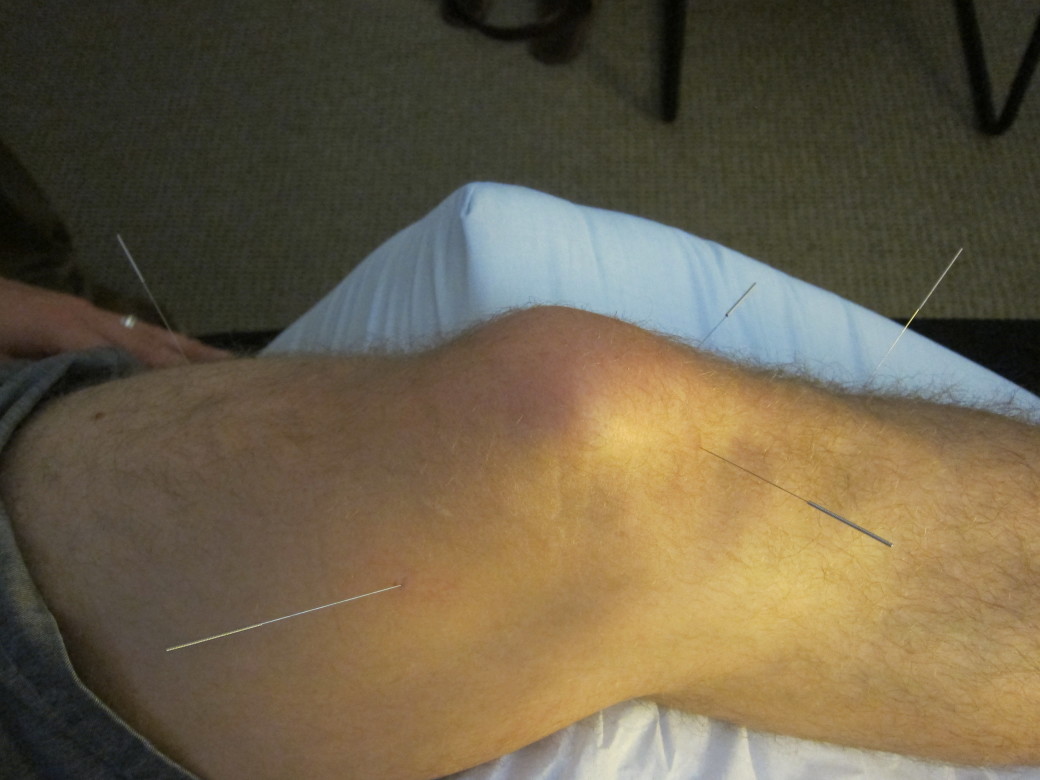 knee pain treatment using sports medicine acupuncture