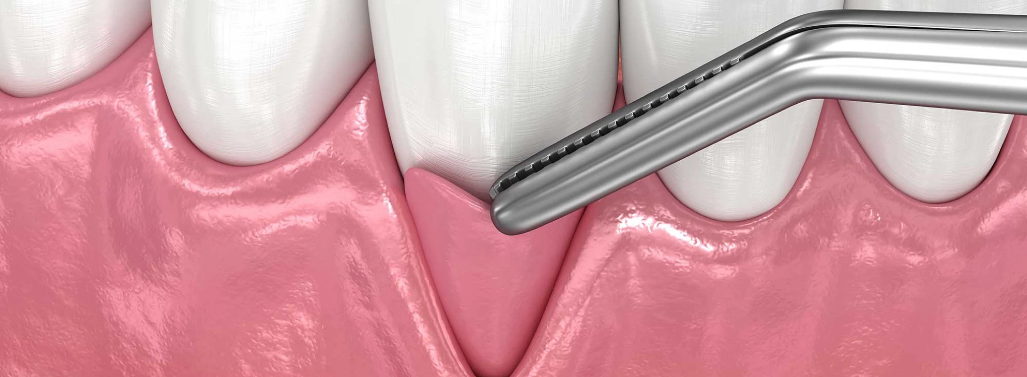 3d illustration of gum graft dental treatment