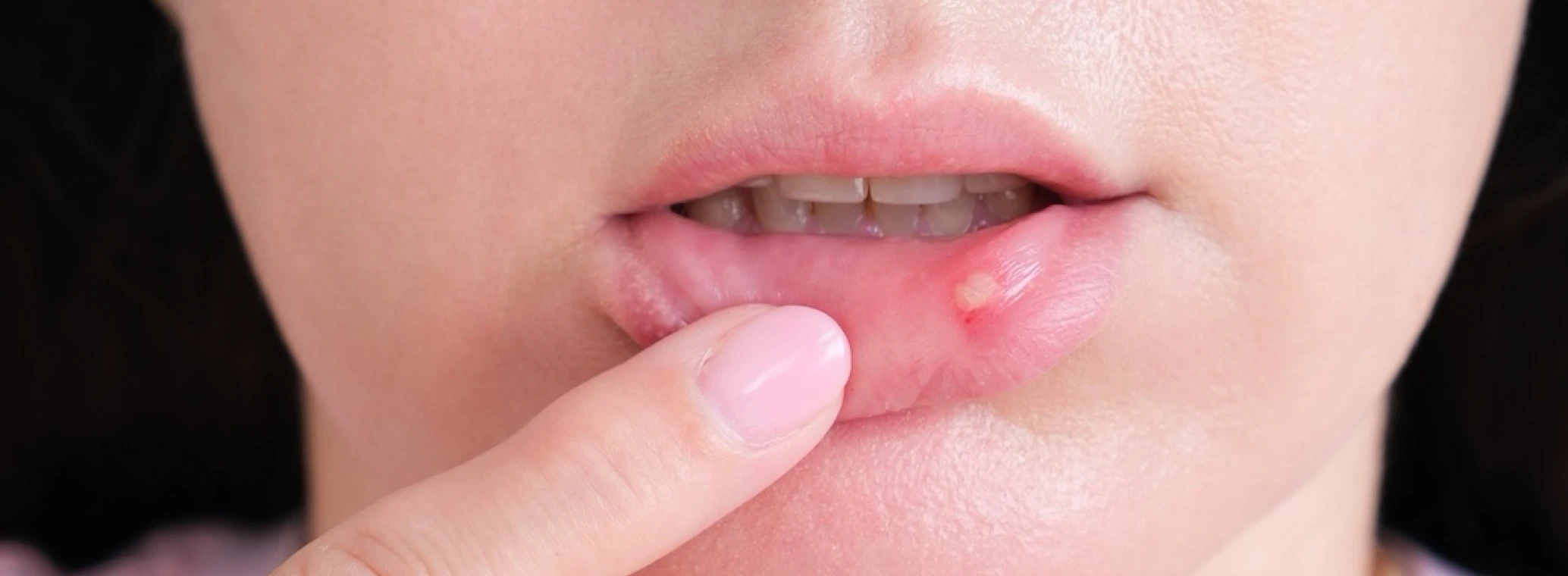 Close-up of a person pointing to a sore on their lower lip. The lip appears swollen with a visible red and white lesion, indicating a possible cold sore or ulcer. The person has a neutral expression.