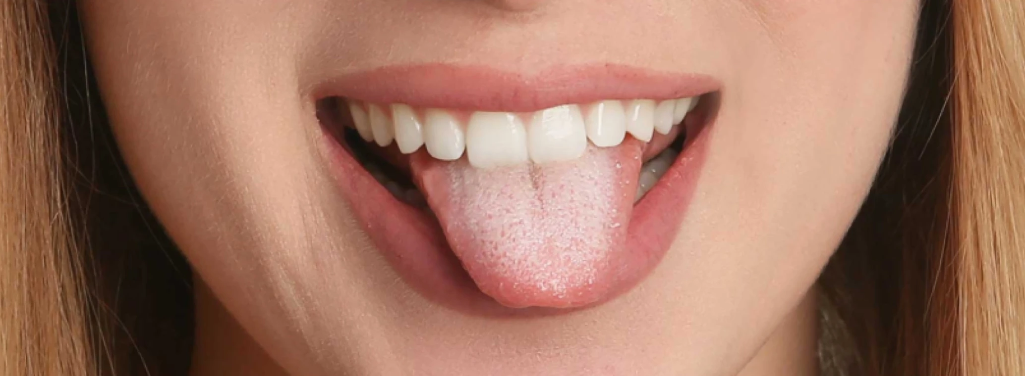 Woman sticking out her tongue with oral thrush symptoms