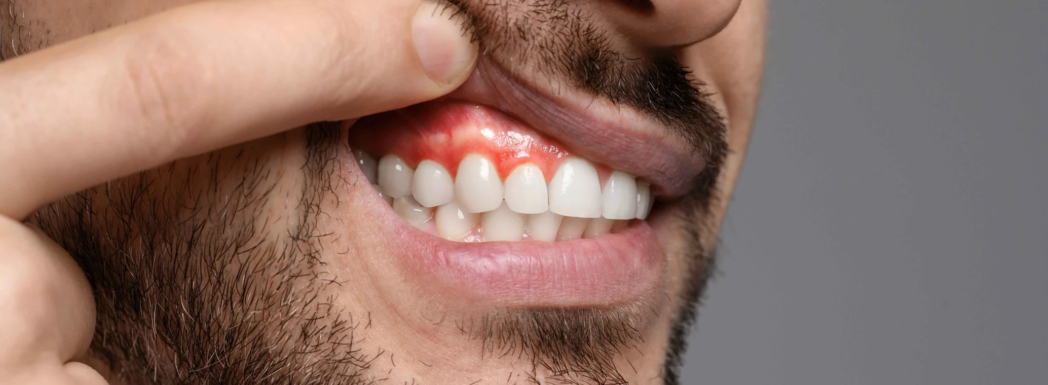 Image of a gum abscess | Crest