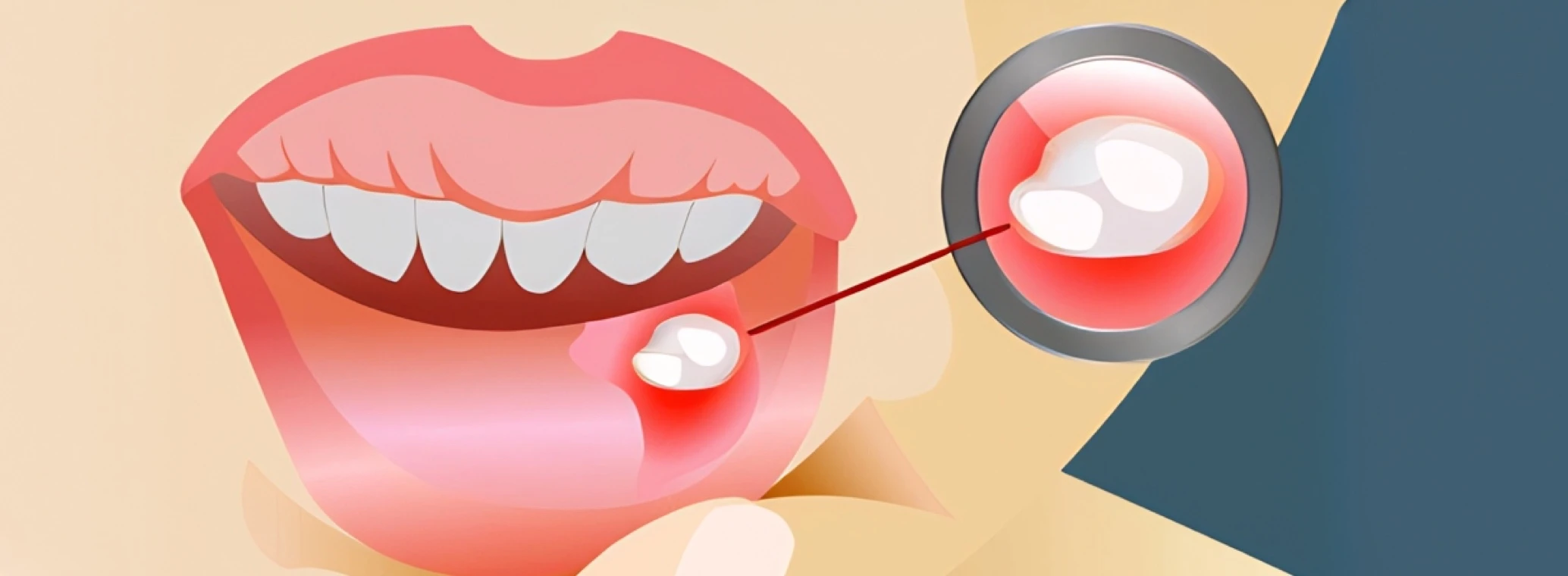 Illustration showing the formation of a canker sore inside the lower lip
