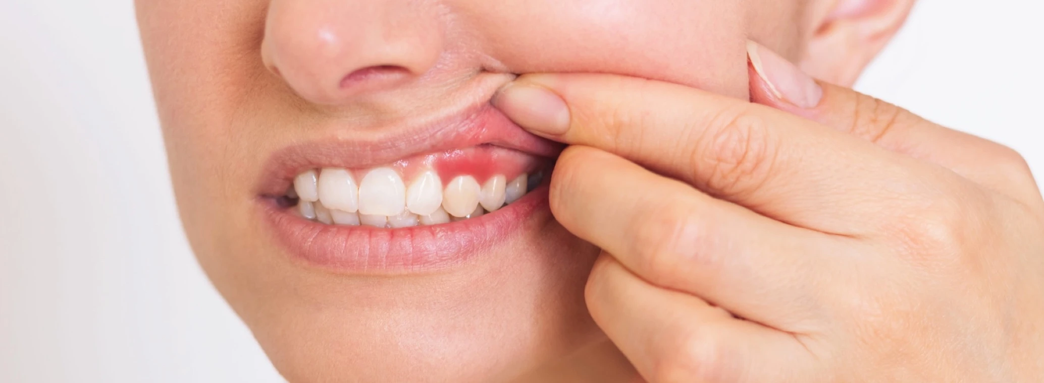 Woman showing red, swollen gums