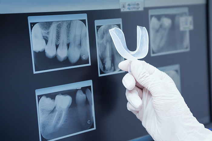 dental x-ray use to create a mouth guard