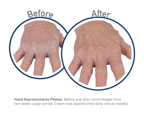 Eczeama Hand Before After Lockup
