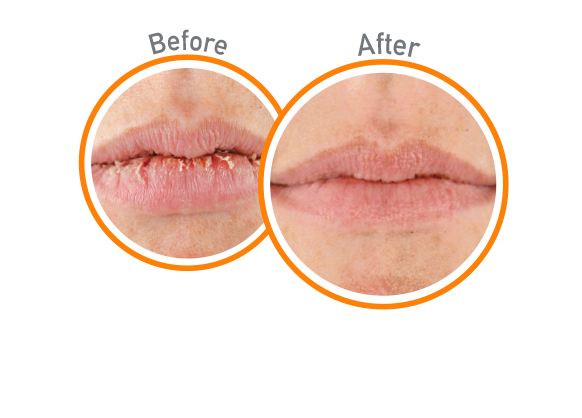 Lip Repair - Before and After Use - Guaranteed Relief for Extremely Dry, Cracked Lips