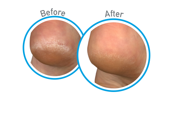 Before and After Use - Guaranteed Relief for Extremely Dry, Cracked Feet