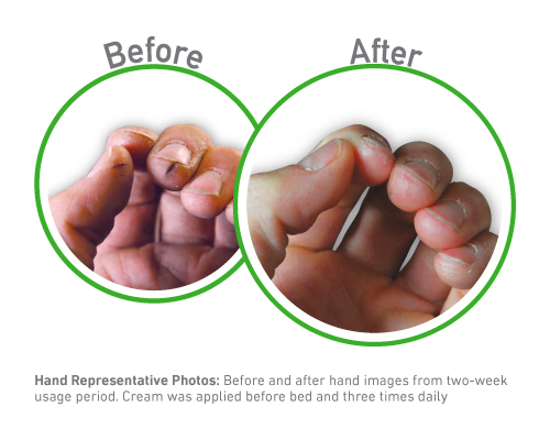 Working Hands - Before and After Use - Guaranteed Relief for Extremely Dry, Cracked Hands