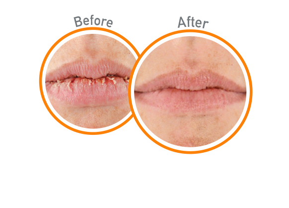 Lip Relief SPF 35 - Before and After Use - Guaranteed Relief for Extremely Dry, Cracked Lips