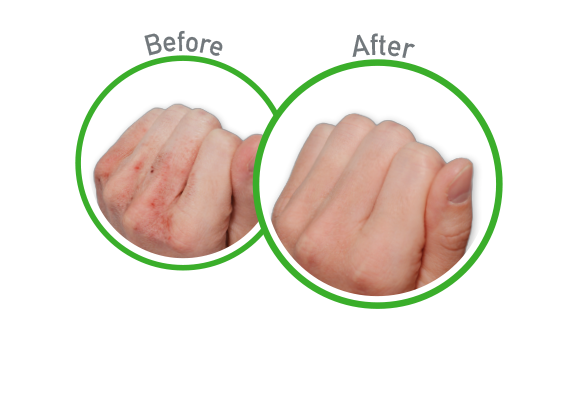 Working Hands - Before and After Use - Guaranteed Relief for Extremely Dry, Cracked Hands