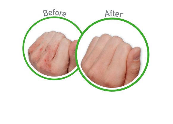 Working Hands Night Relief - Before and After Use - Guaranteed Relief for Extremely Dry, Cracked Hands