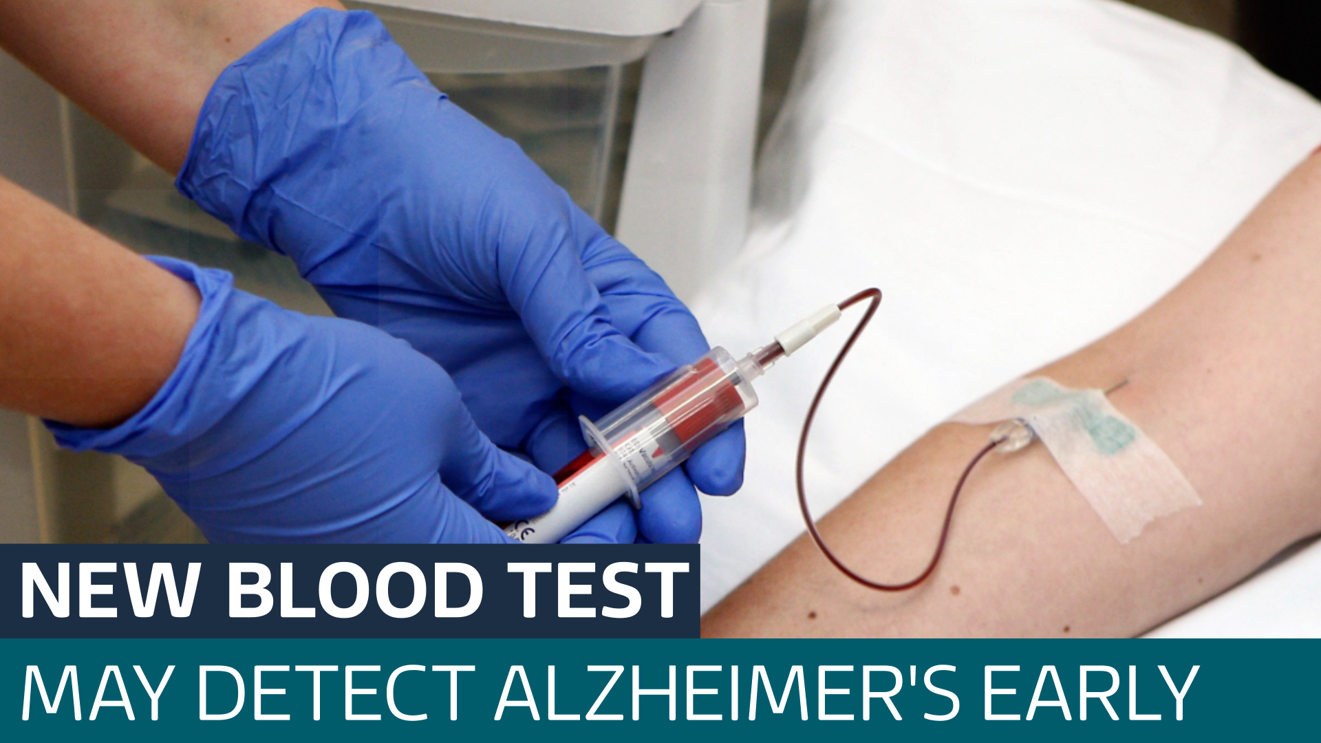 New Blood Test Could Help Diagnose Alzheimer S Before Brain Starts To