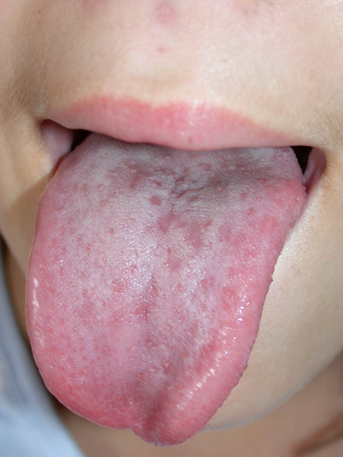 vésicules sur la langue