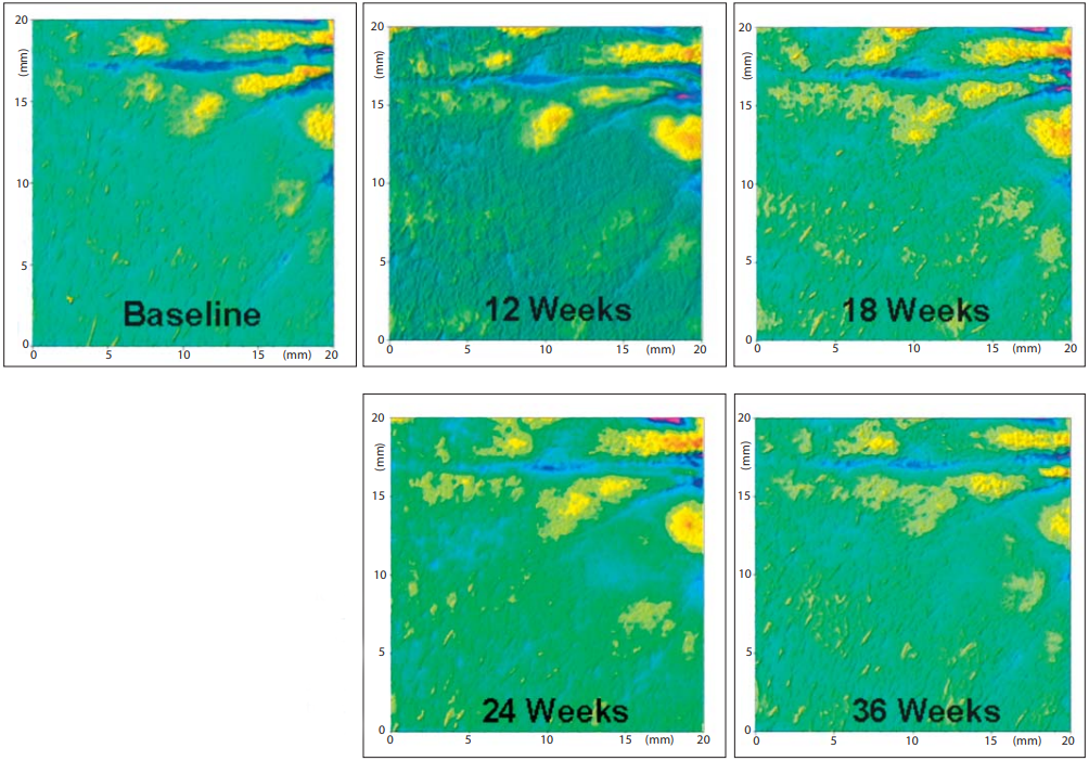 ROL improves the three-dimensional appearance of fine lines. Representative surface profilometry images demonstrating the three-dimensional appearance of fine lines of a volunteer treated
with 0.1% ROL in the course of the study.
The imaged area corresponds to the crow’s
feet region on the side of the eyes.