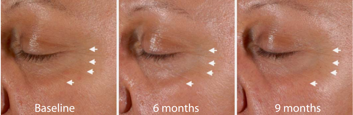 ROL improves the visible appearance of fine lines. Representative images of a volunteer treated with 0.1%
ROL at baseline, 24 and 36 weeks. Arrows point to fine lines that improve their appearance in the course of the
study.