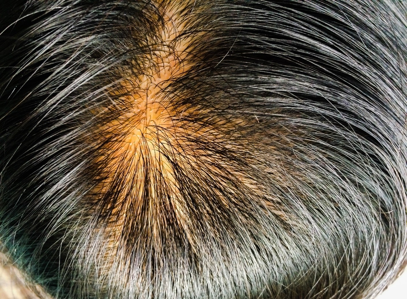Oily Hair Problems and Causes