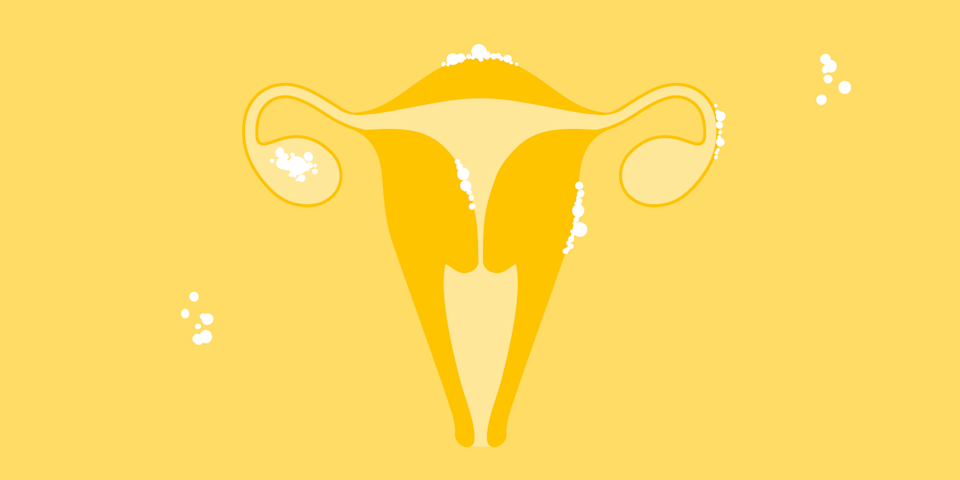 Na endometriose, o útero forma um tecido semelhante ao endométrio fora de onde o endométrio cresce.