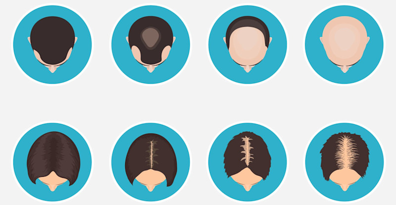Image1 DE Hair Transplant Cost Guide