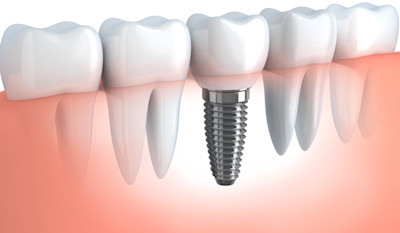 DE image 1 for Dental Implant Cost Guide