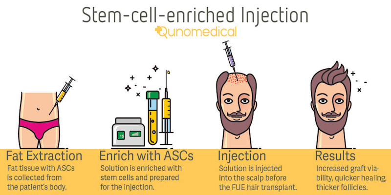 stemcellenrichedInjection_Image
