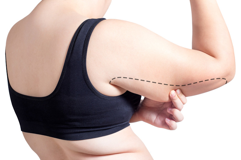 DE image 1 for Liposuction Cost Guide