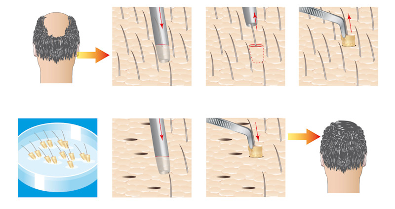 DE Image2_Hair Transplant Cost Guide