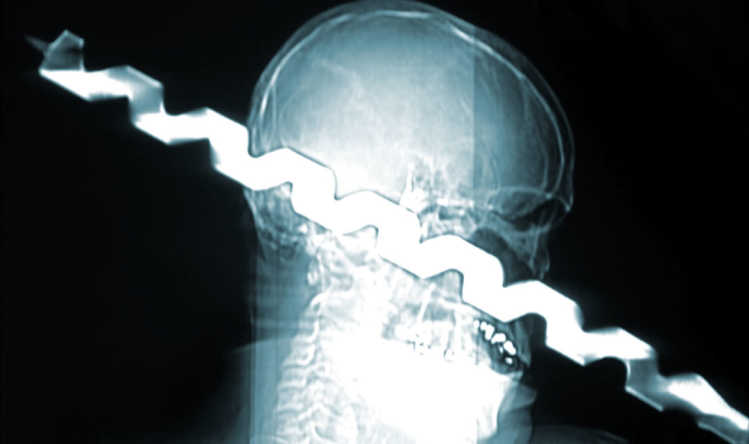 Ron Hunt drill bit through skull X-Ray