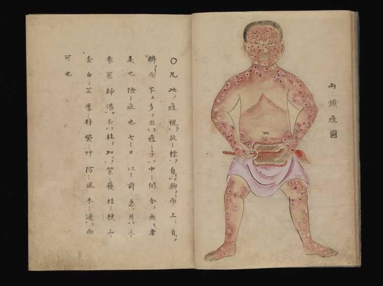Smallpox illustration, Japanese manuscript, c. 1720 Wellcome L0074716