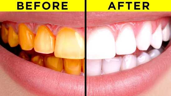 Simple Tricks For Whiter Teeth