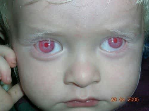 albino red pink eyes