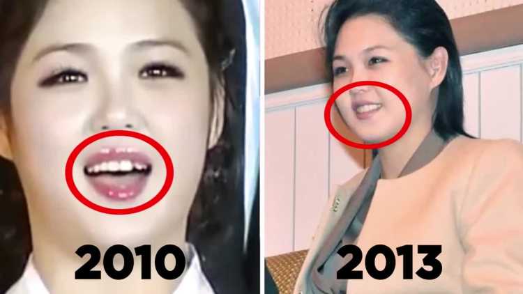 Kim Jong-un Wife Ro Sol Ju teeth dental fixed
