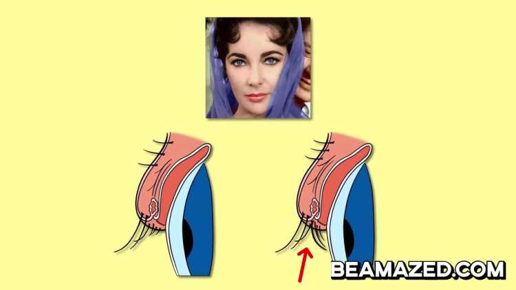Elizabeth Taylor distichiasis double row of eyelashes