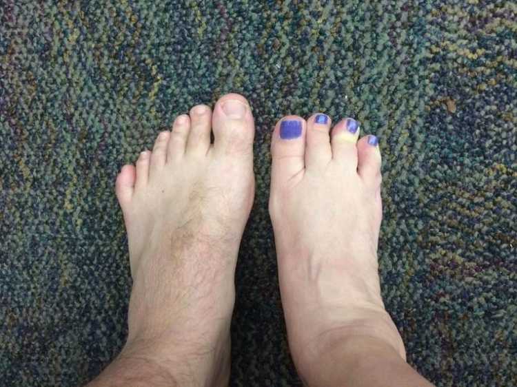 5 toes and 4 toes