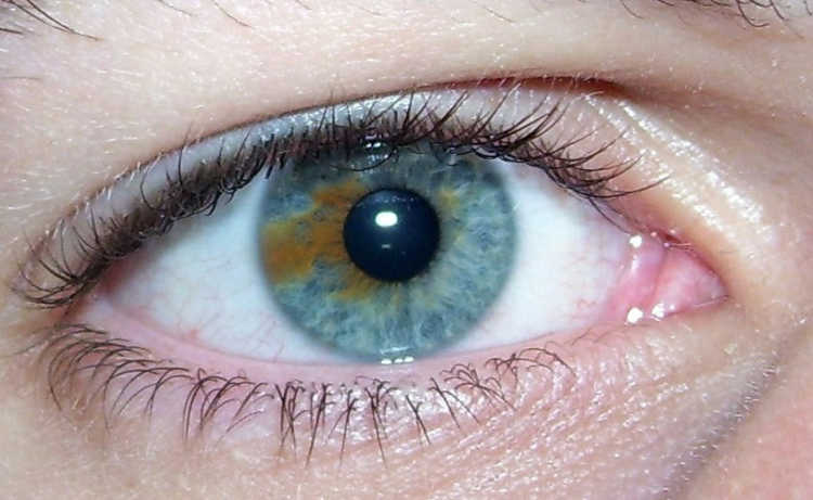sectoral heterochromia Multicoloured Eyes human