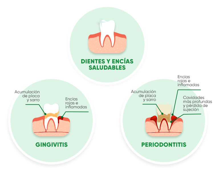 Enfermedades Bucodentales Gingivitis Peridontitis