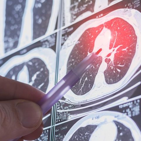 Chest CT image. Lung parenchyma. Disease of lungs.