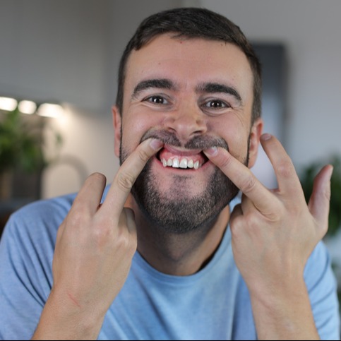 Man Showing Early Signs of Gingivitis