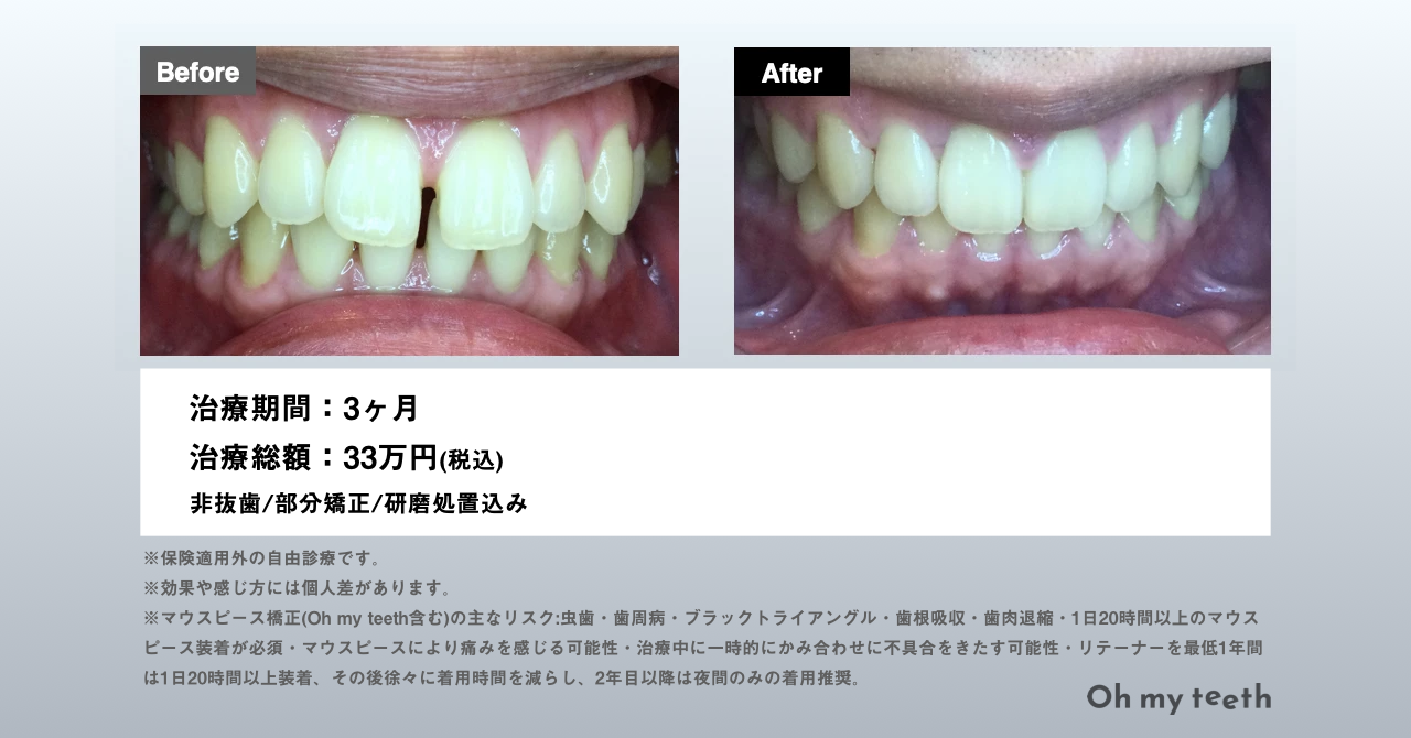 マウスピース矯正 Oh my teethのすきっ歯(空隙歯列)の症例