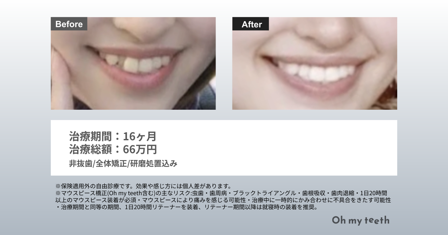 八重歯症例Pro
